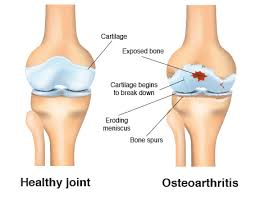 Inflammatory Arthritis